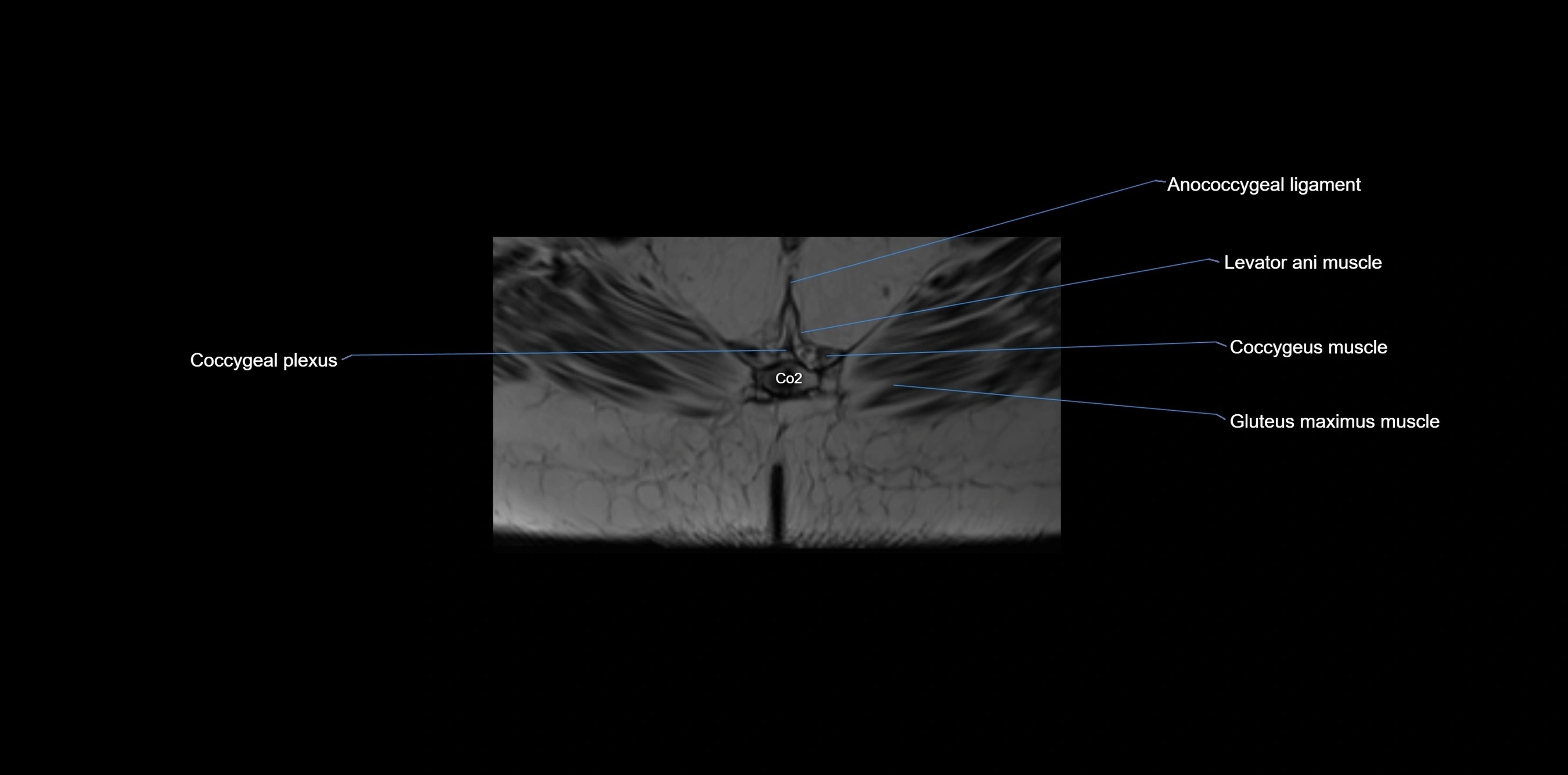 MRI sacrum, coccyx and sacroiliac joint axial cross sectional anatomy 3T  radiology  image-img-00001-00075.webp